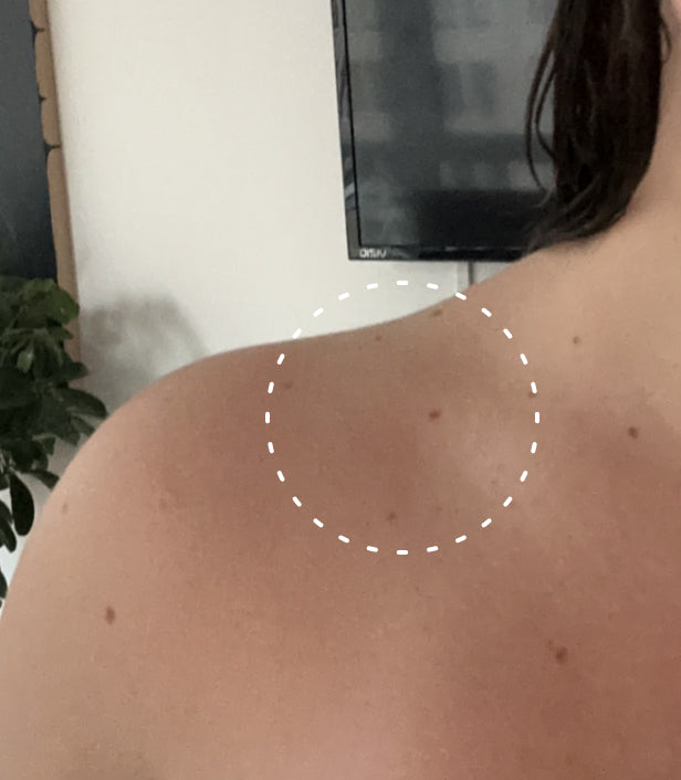 Image of person who previously had a sunburn on their shoulder but now it has healed